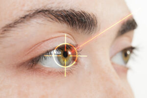 Chirurgie réfractive de l'œil par opération laser
