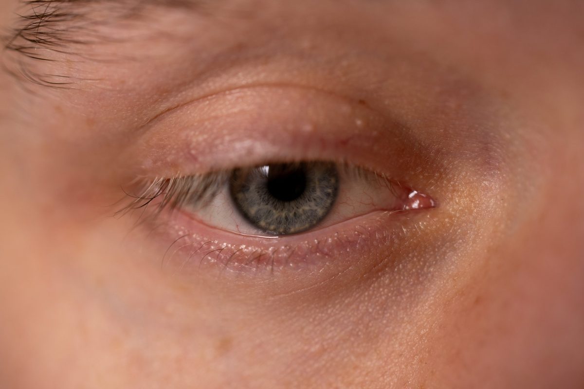 Gros plan sur l’œil et la paupière supérieure d’un patient, ptosis ou relâchement de la paupière